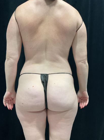 After Image: Lipo 360 and Skin Tightening - back