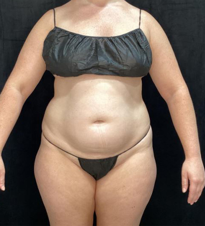 Before Image: Lipo 360 and Skin Tightening - front