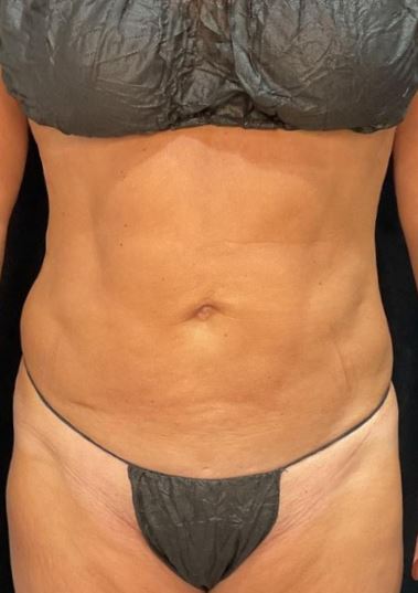 After Image: Lipo 360 and Skin Tightening - front