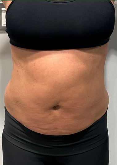 Before Image: Lipo 360 and Skin Tightening - front