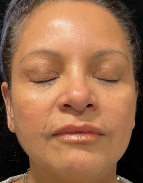 After Image: Microneedling & Moxi with Exosomes - front