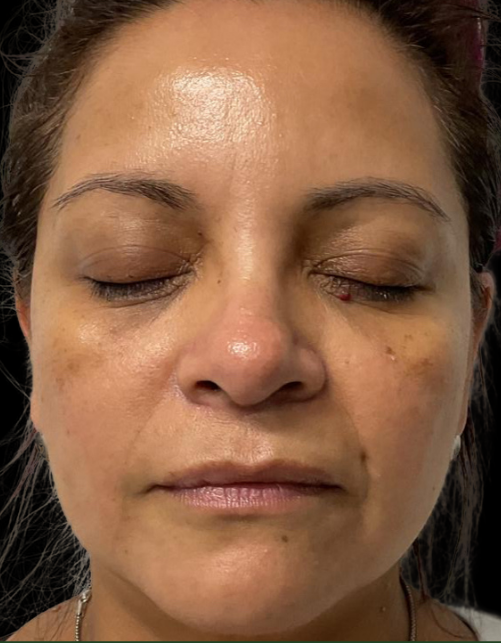 Before Image: Microneedling & Moxi with Exosomes - front