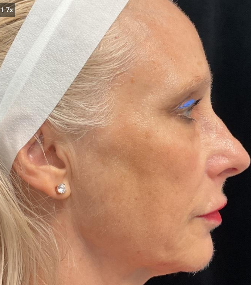 After Image: Microneedling & Moxi with Exosomes - right-side