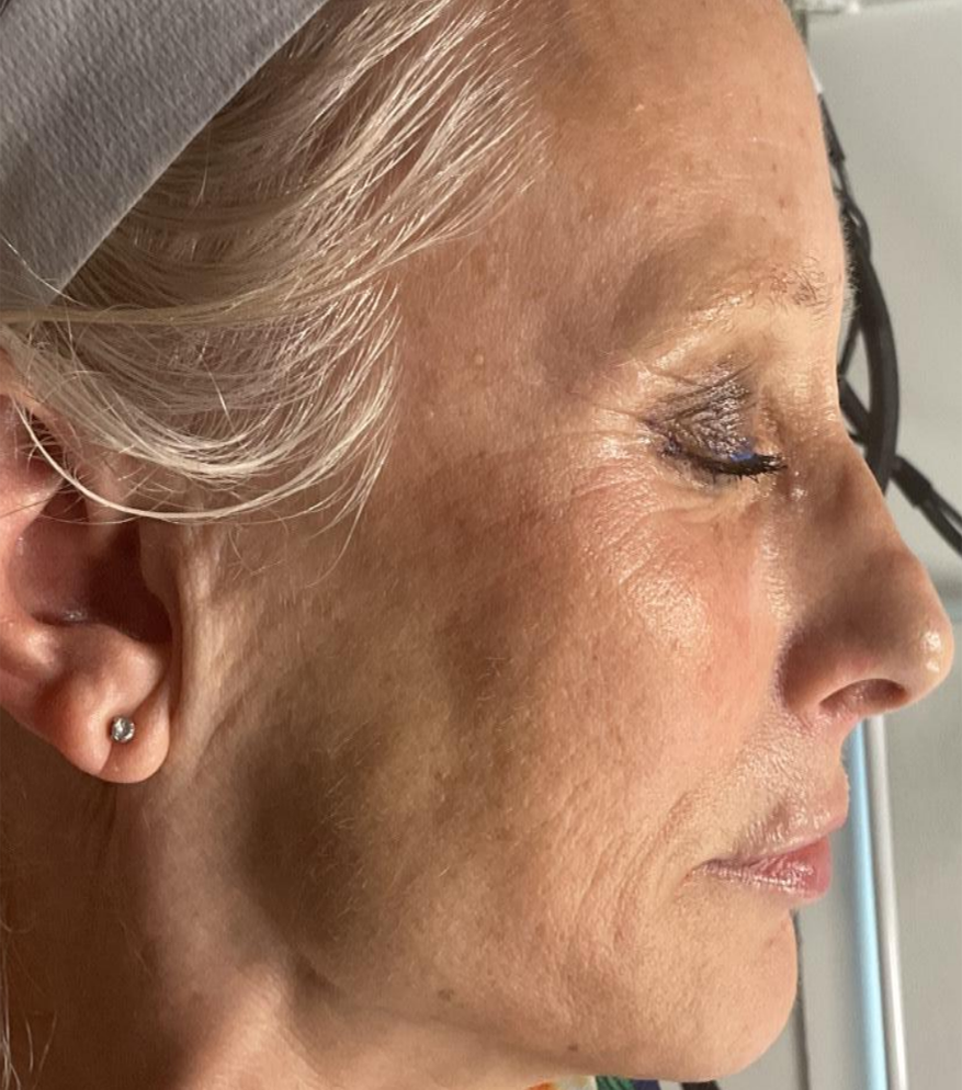 Before Image: Microneedling & Moxi with Exosomes - right-side