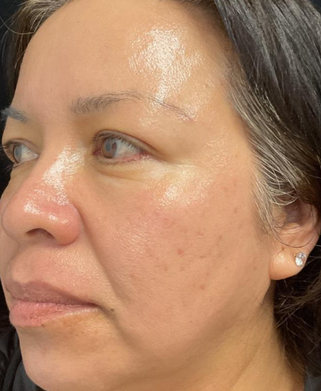 After Image: Microneedling & Tixel - left-front-oblique