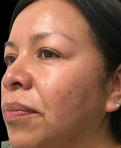 Before Image: Microneedling & Tixel - left-front-oblique