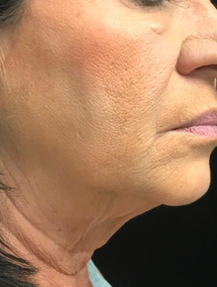 Before Image: Tixel - right-side