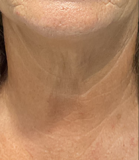 After Image: Tixel - front