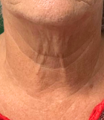 Before Image: Tixel - front