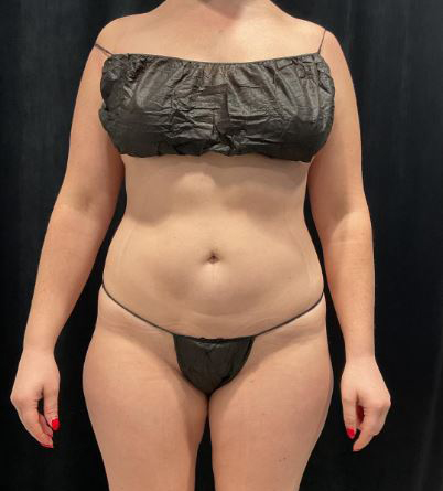 After Image: Lipo 360 and Skin Tightening - front