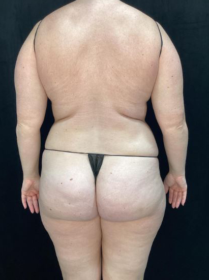 Before Image: Lipo 360 and Skin Tightening - back