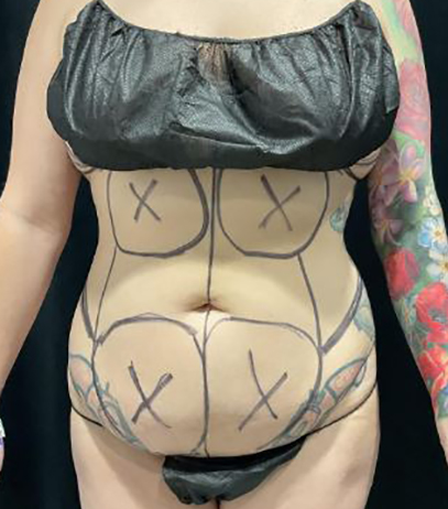 Before Image: Lipo 360 and Skin Tightening - front