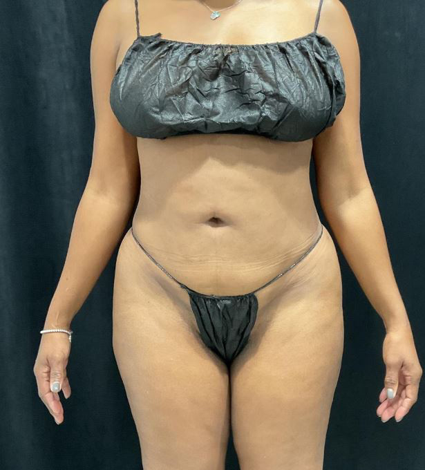 After Image: Lipo 360 and Skin Tightening - front