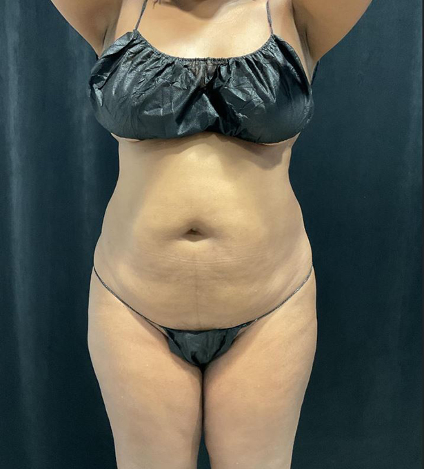Before Image: Lipo 360 and Skin Tightening - front