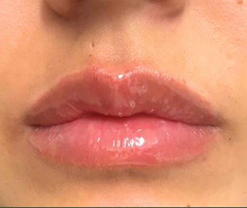 After Image: Lip Filler - front