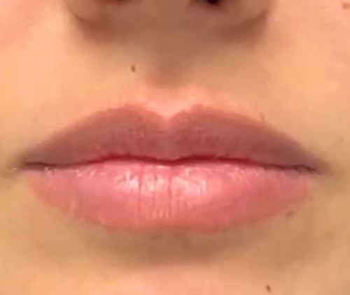 Before Image: Lip Filler - front