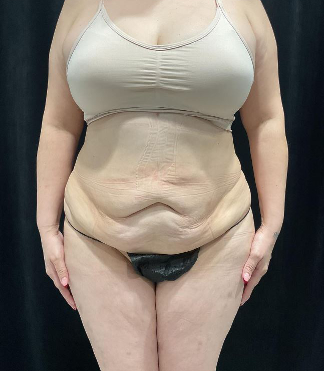 After Image: Lipo 360 and Skin Tightening - front