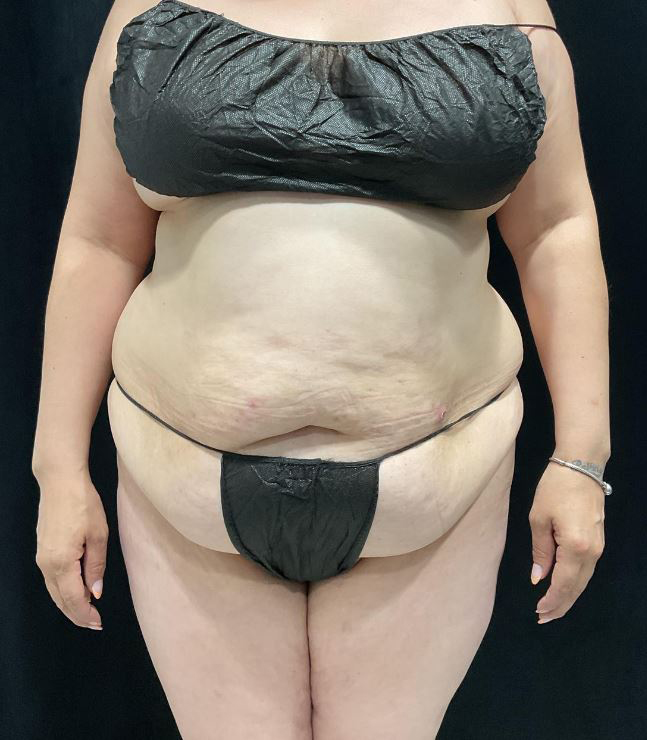 Before Image: Lipo 360 and Skin Tightening - front